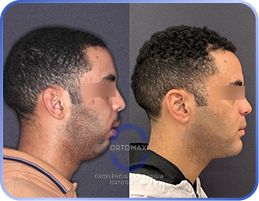 Cirurgia-Ortognática-Antes-e-Depois (10)