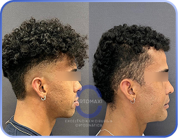 Cirurgia-Ortognática-Antes-e-Depois (11)