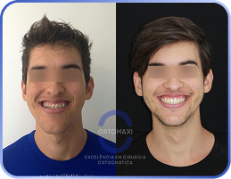 Cirurgia-Ortognática-Antes-e-Depois (14)