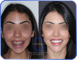 Cirurgia-Ortognática-Antes-e-Depois (15)