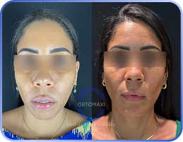 Cirurgia-Ortognática-Antes-e-Depois (16)