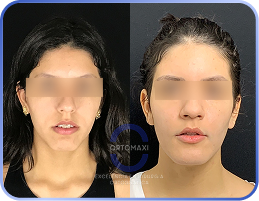 Cirurgia-Ortognática-Antes-e-Depois (17)