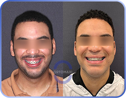 Cirurgia-Ortognática-Antes-e-Depois (18)