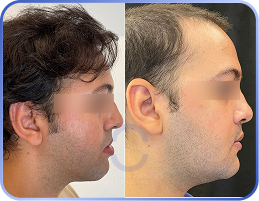 Cirurgia-Ortognática-Antes-e-Depois (19)