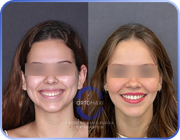 Cirurgia-Ortognática-Antes-e-Depois (2)