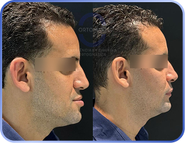 Cirurgia-Ortognática-Antes-e-Depois (20)