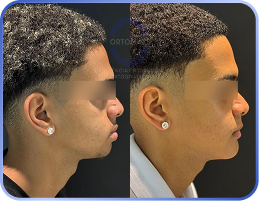 Cirurgia-Ortognática-Antes-e-Depois (21)