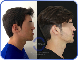 Cirurgia-Ortognática-Antes-e-Depois (3)