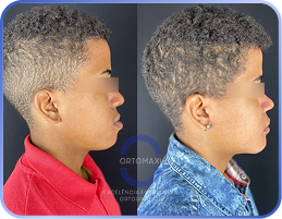 Cirurgia-Ortognática-Antes-e-Depois (4)