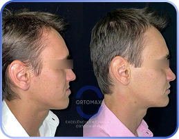 Cirurgia-Ortognática-Antes-e-Depois (5)