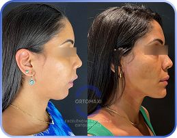 Cirurgia-Ortognática-Antes-e-Depois (6)