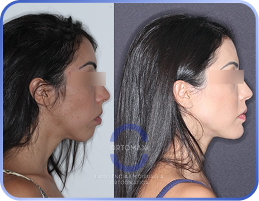 Cirurgia-Ortognática-Antes-e-Depois (7)