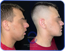 Cirurgia-Ortognática-Antes-e-Depois (8)