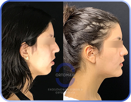 Cirurgia-Ortognática-Antes-e-Depois (9)