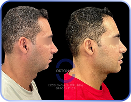 antes-e-depois-classe-2 (2)