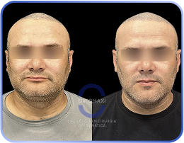 antes-e-depois-rosto-curto