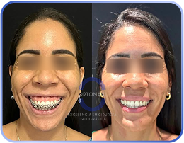 antes-e-depois-sorriso-gengival