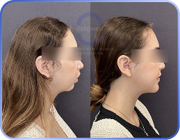 cirurgia-ortognática-antes-e-depois (1)