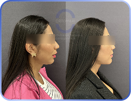 cirurgia-ortognática-antes-e-depois (2)