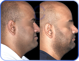 cirurgia-ortognática-antes-e-depois (3)