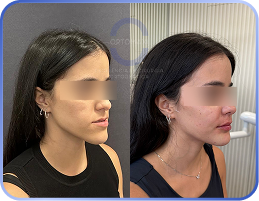 cirurgia-ortognática-antes-e-depois (4)