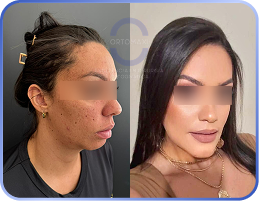 cirurgia-ortognática-antes-e-depois (5)