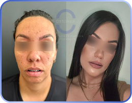 cirurgia-ortognática-antes-e-depois (6)