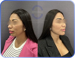 cirurgia-ortognática-antes-e-depois (8)