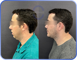 cirurgia-ortognática-antes-e-depois (9)