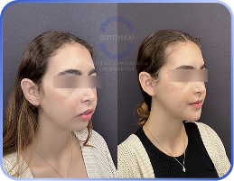 cirurgia-ortognática-antes-e-depois